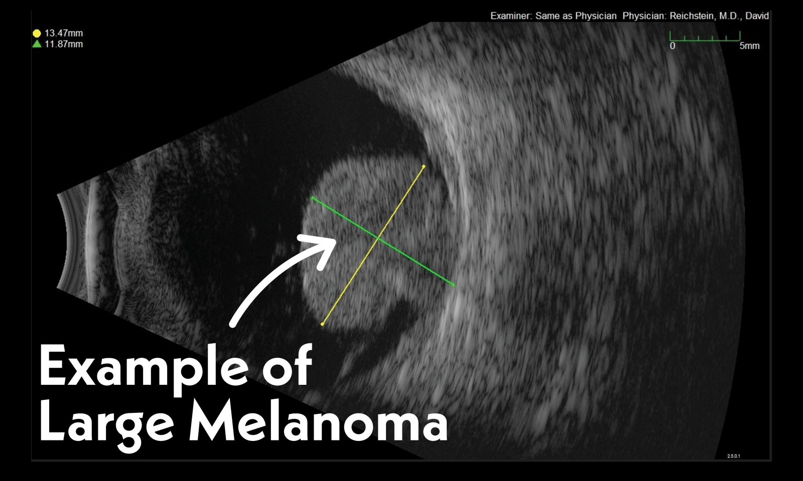 What Does a B Scan Ocular Ultrasound Capture and Why is it Necessary ...