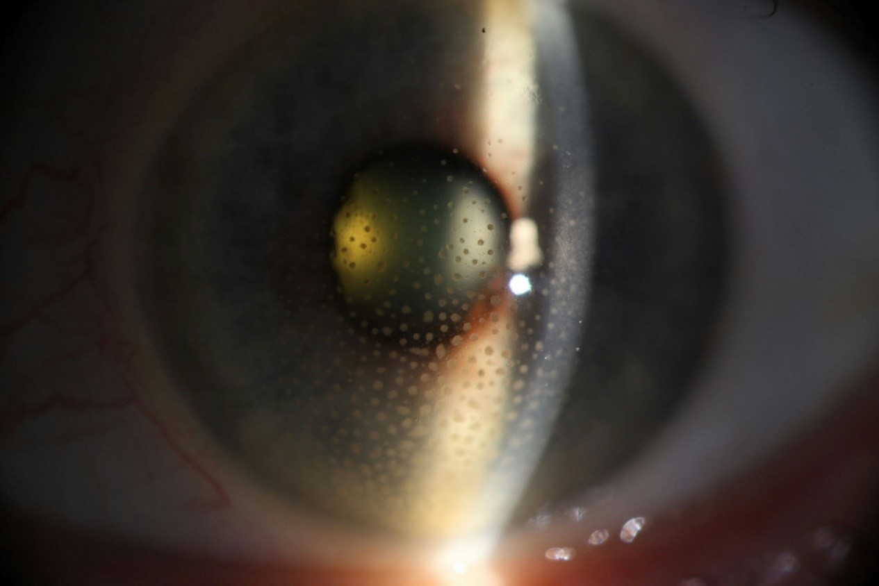 symptoms of uveitis image