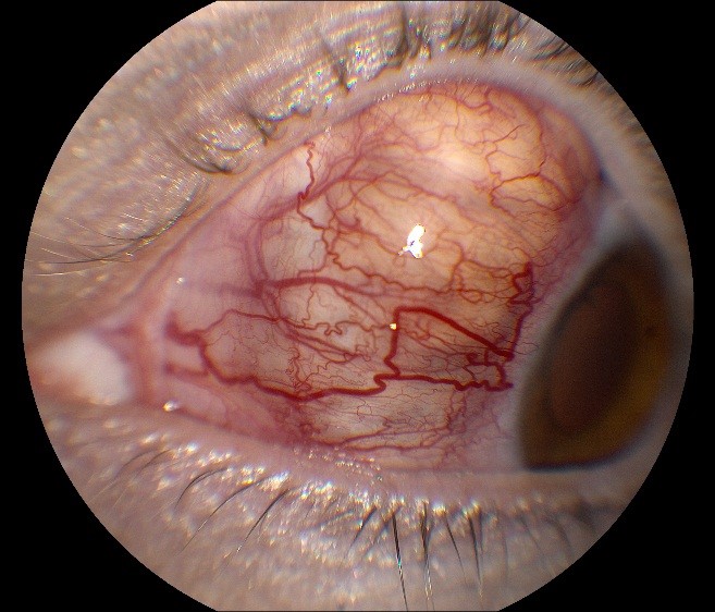 types of uveitis image