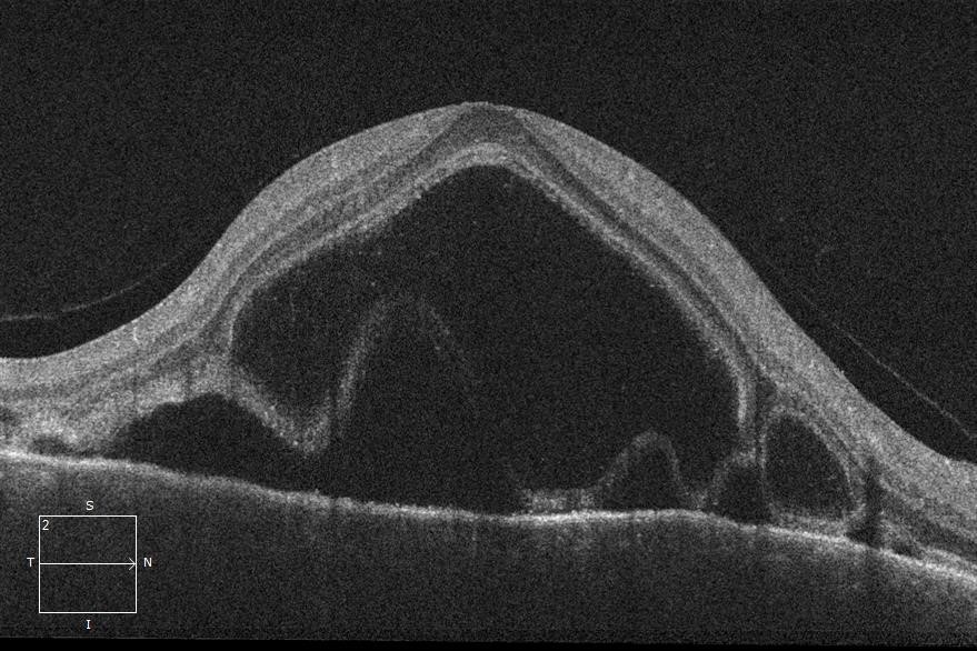 uveitis patients image